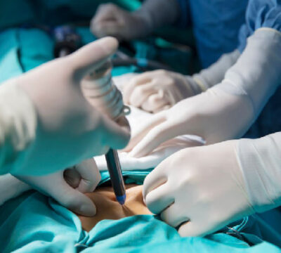 Gastrointestinal-surgery